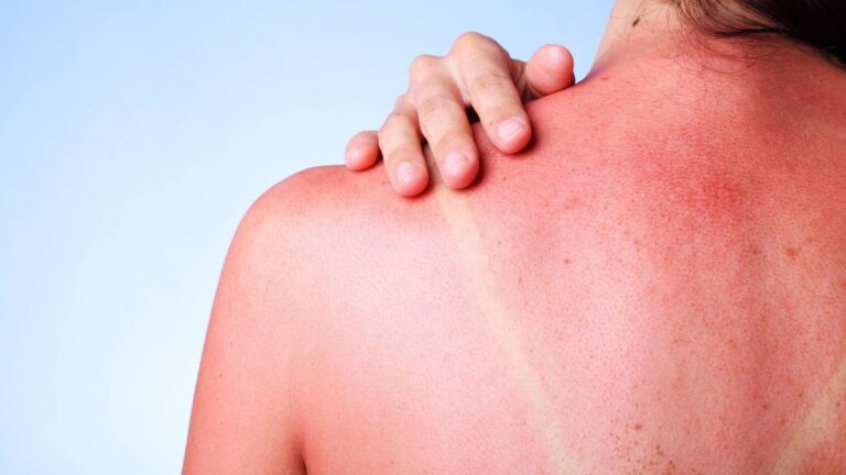Ola de calor e insolación: remedios buenos y baratos para remediar el exceso de sol